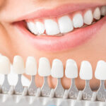 Porcelain veneers